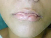 Volunteer Reconstructive Surgery - Case 295 - After