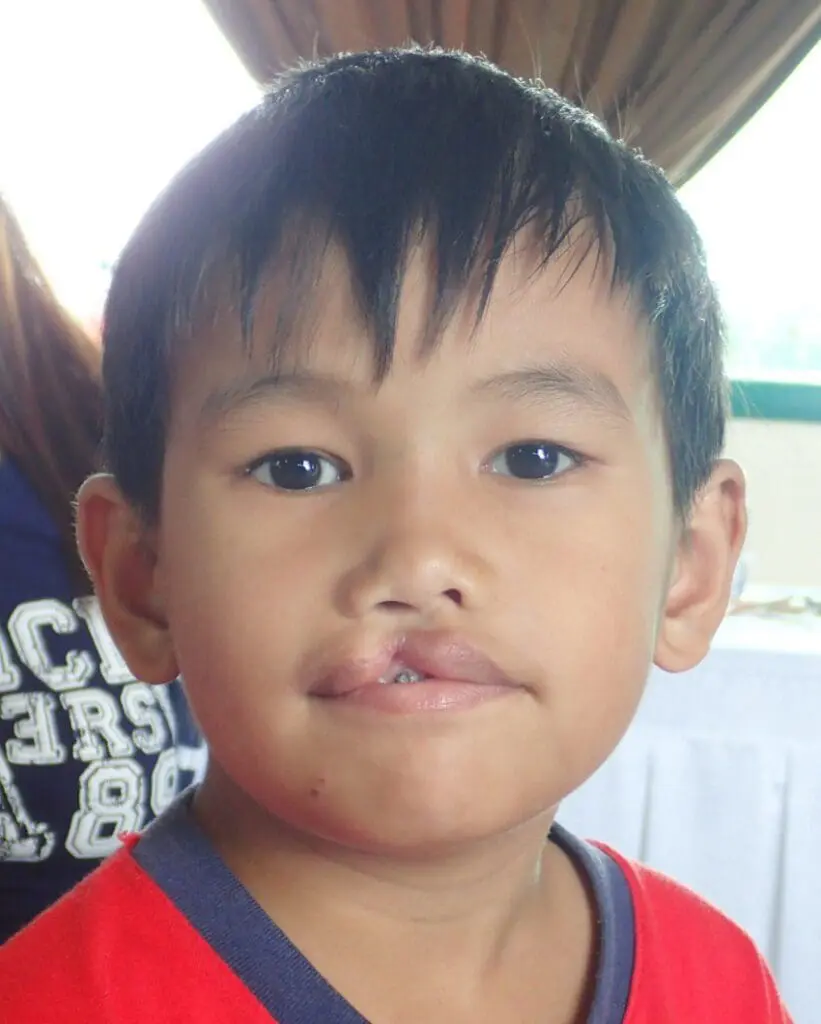 Volunteer Reconstructive Surgery - Case 1485 - Before