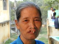 Volunteer Reconstructive Surgery - Case 275 - Before