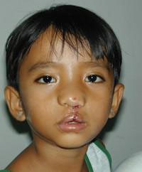 Volunteer Reconstructive Surgery - Case 286 - After