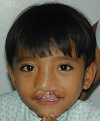 Volunteer Reconstructive Surgery - Case 286 - Before