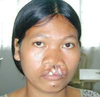 Volunteer Reconstructive Surgery - Case 271 - Before