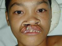 Volunteer Reconstructive Surgery - Case 281 - Before