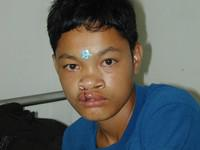 Volunteer Reconstructive Surgery - Case 281 - After