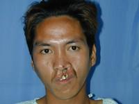 Volunteer Reconstructive Surgery - Case 287 - Before