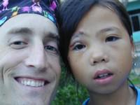 Volunteer Reconstructive Surgery - Case 285 - Before