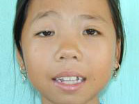 Volunteer Reconstructive Surgery - Case 285 - After