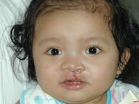 Volunteer Reconstructive Surgery - Case 294 - After