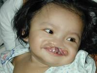 Volunteer Reconstructive Surgery - Case 294 - Before