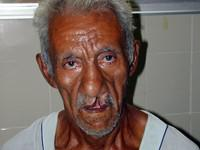 Volunteer Reconstructive Surgery - Case 297 - Before