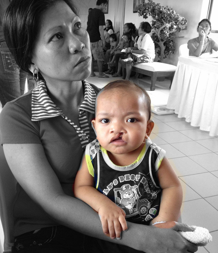 Volunteer Reconstructive Surgery - Case 316 - Before