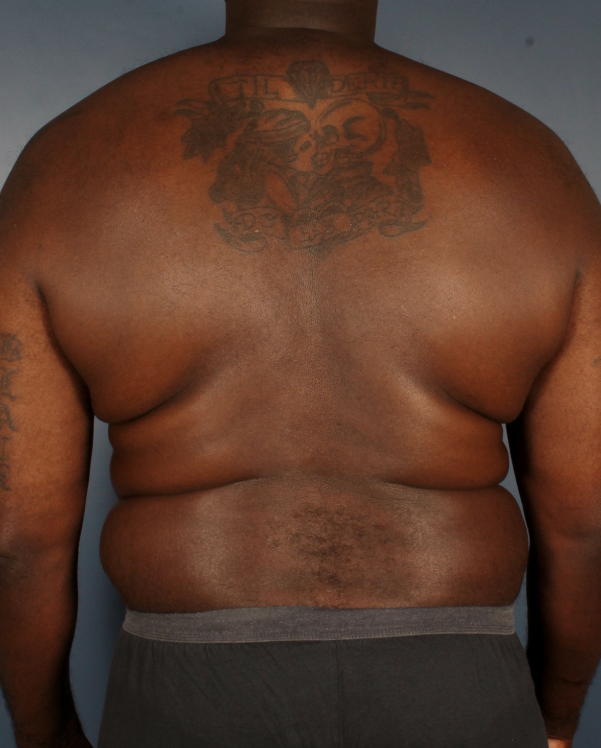 Male Liposuction Patient Photo - Case 1476 - before view-1