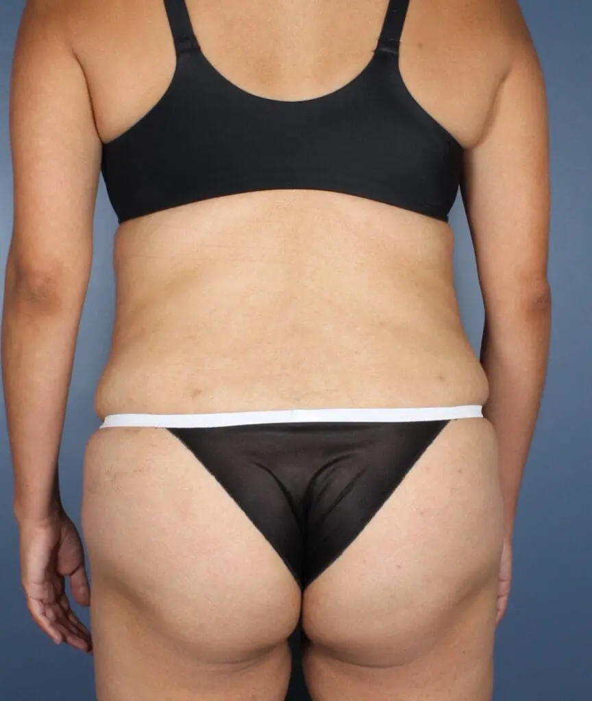 Liposuction - Case 1472 - After