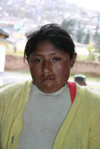 Volunteer Reconstructive Surgery - Case 272 - Before