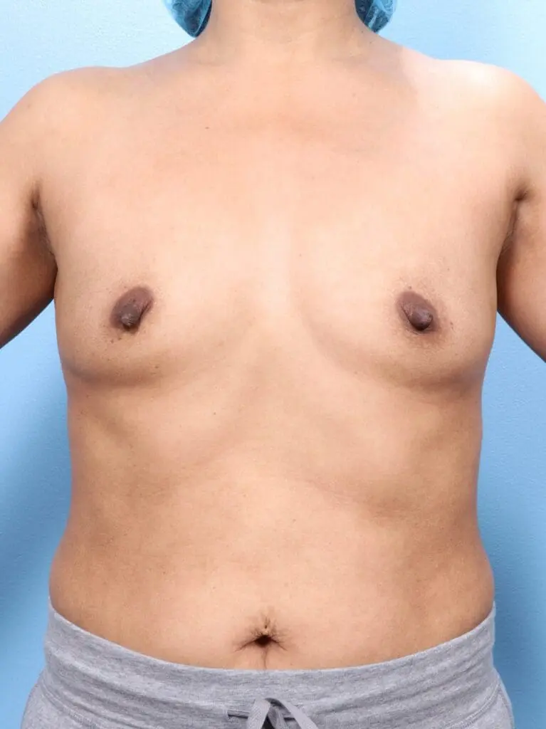 Breast Augmentation - Case 1659 - Before