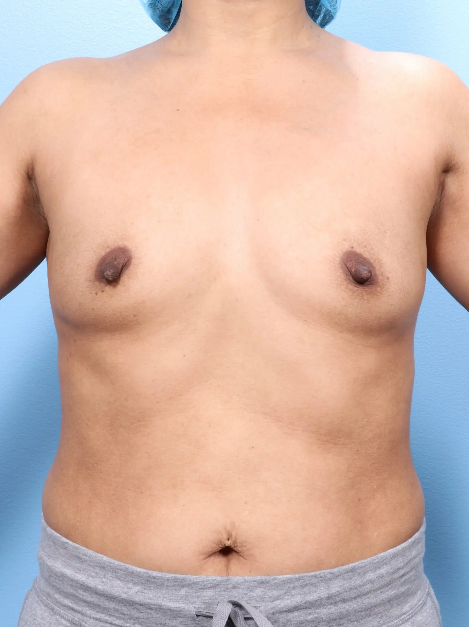 Breast Augmentation Patient Photo - Case 1659 - before view-