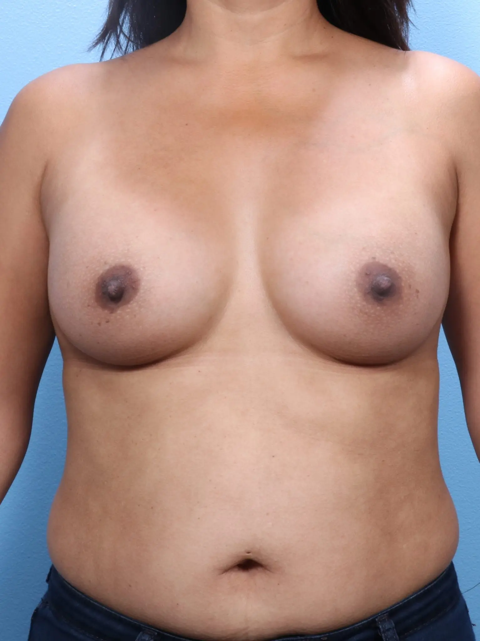 Breast Augmentation Patient Photo - Case 1659 - after view