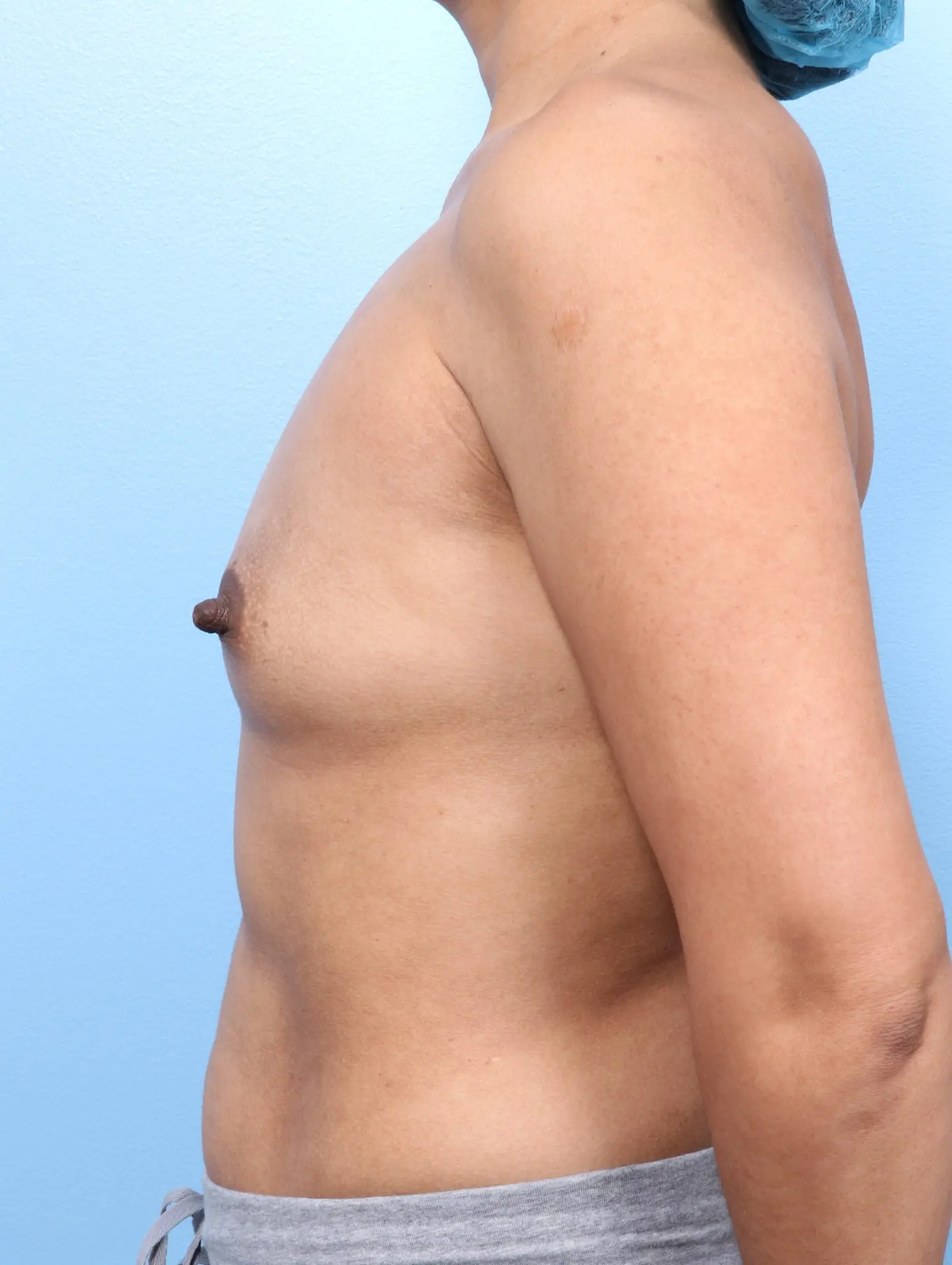 Breast Augmentation Patient Photo - Case 1659 - before view-2