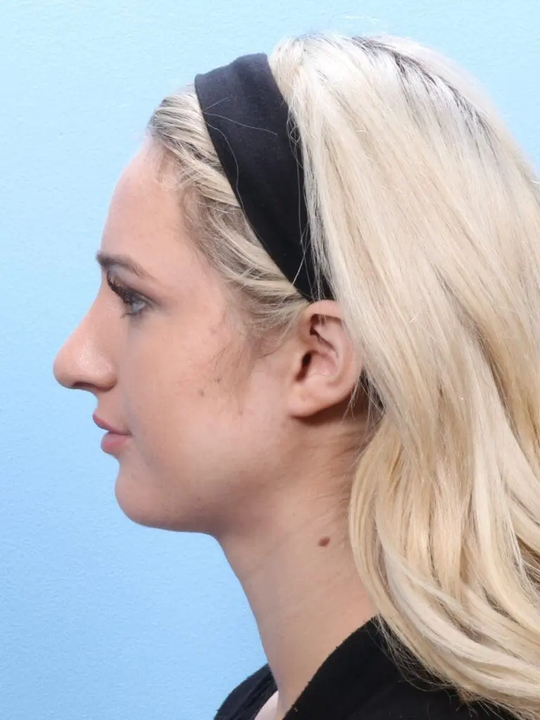 Rhinoplasty - Case 1668 - After