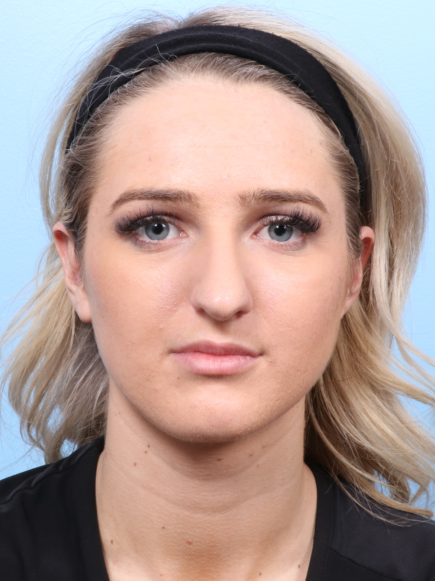 Rhinoplasty Patient Photo - Case 1668 - before view-1
