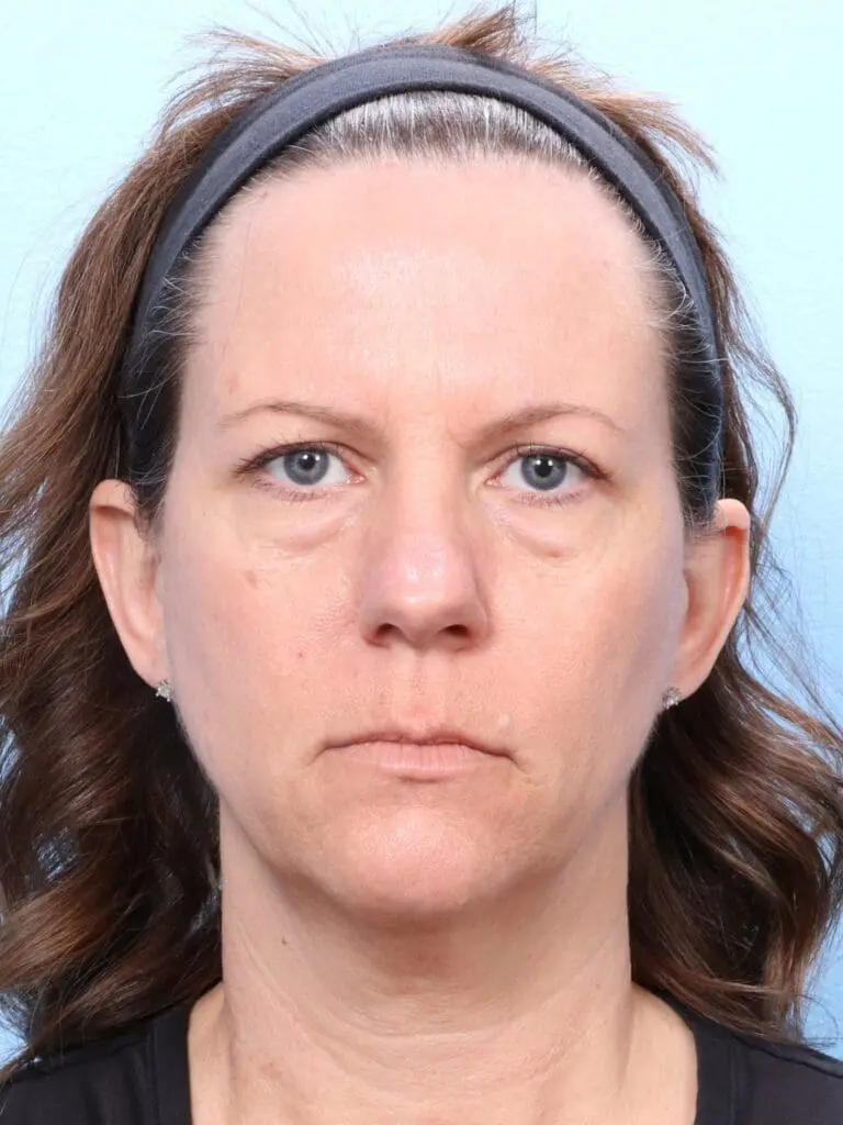 Eyelid Surgery - Case 1678 - Before