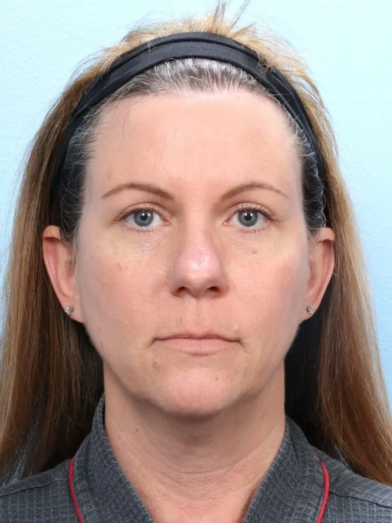 Brow Lift - Case 1678 - After