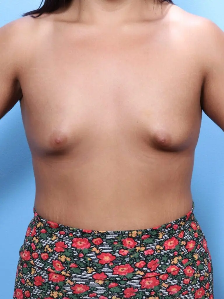 Breast Augmentation - Case 1682 - Before