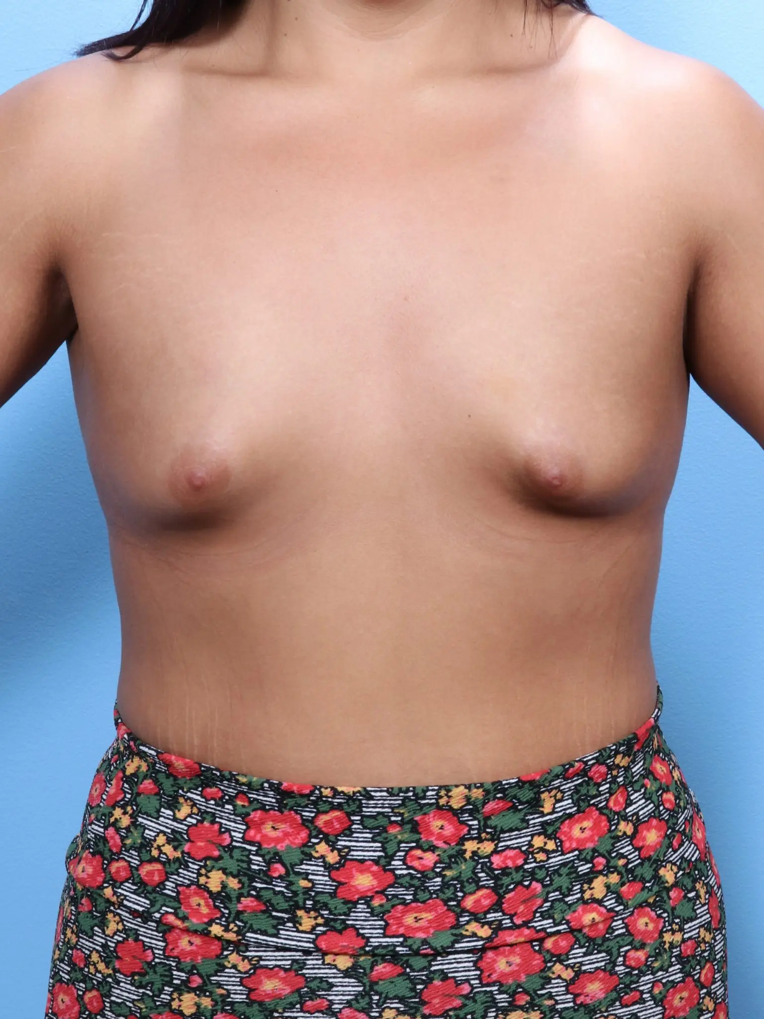Breast Augmentation Patient Photo - Case 1682 - before view-