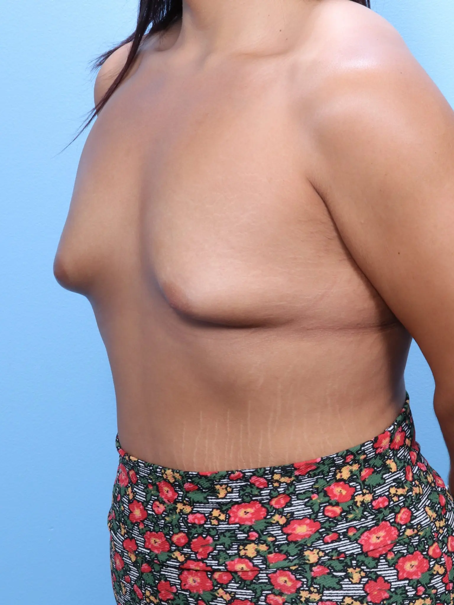 Breast Augmentation Patient Photo - Case 1682 - before view-1