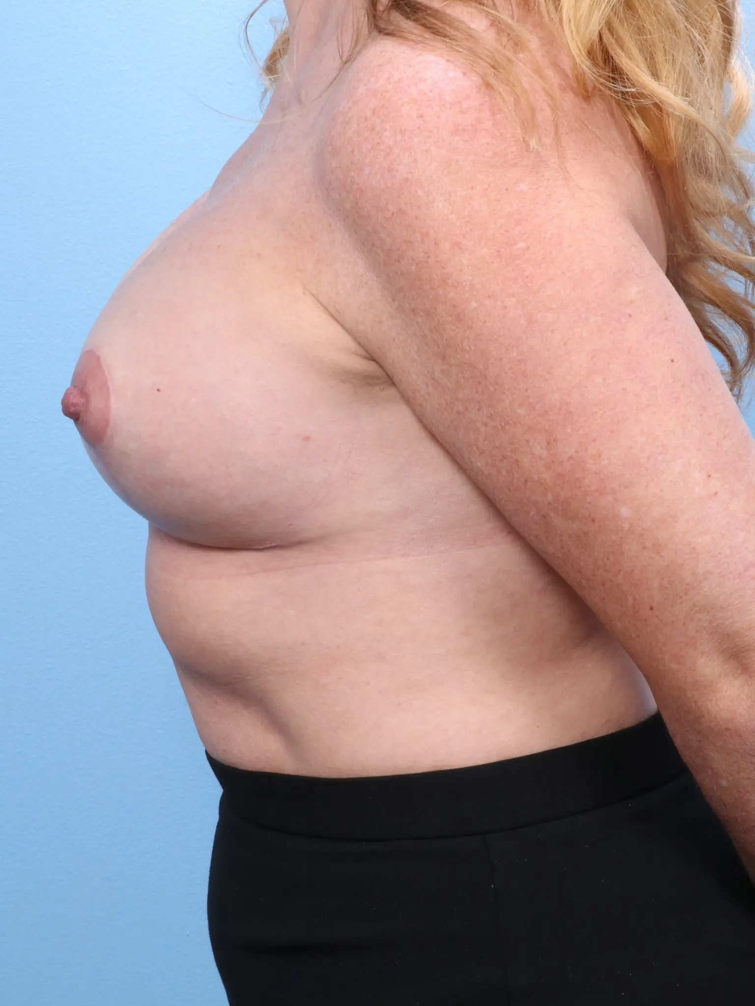 Breast Lift/Reduction with Implants Patient Photo - Case 1683 - after view-2