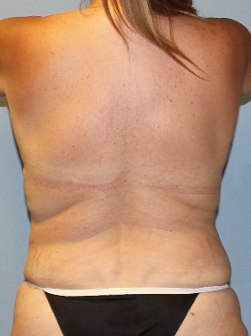 After CoolSculpting