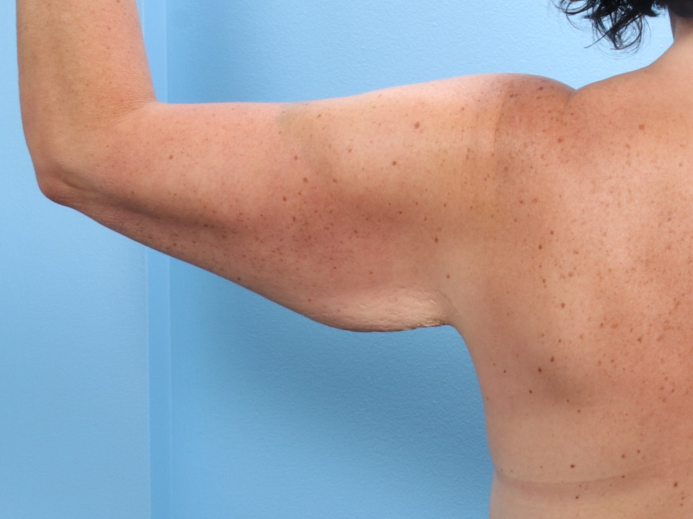 Arm Lift - Case 1698 - Before