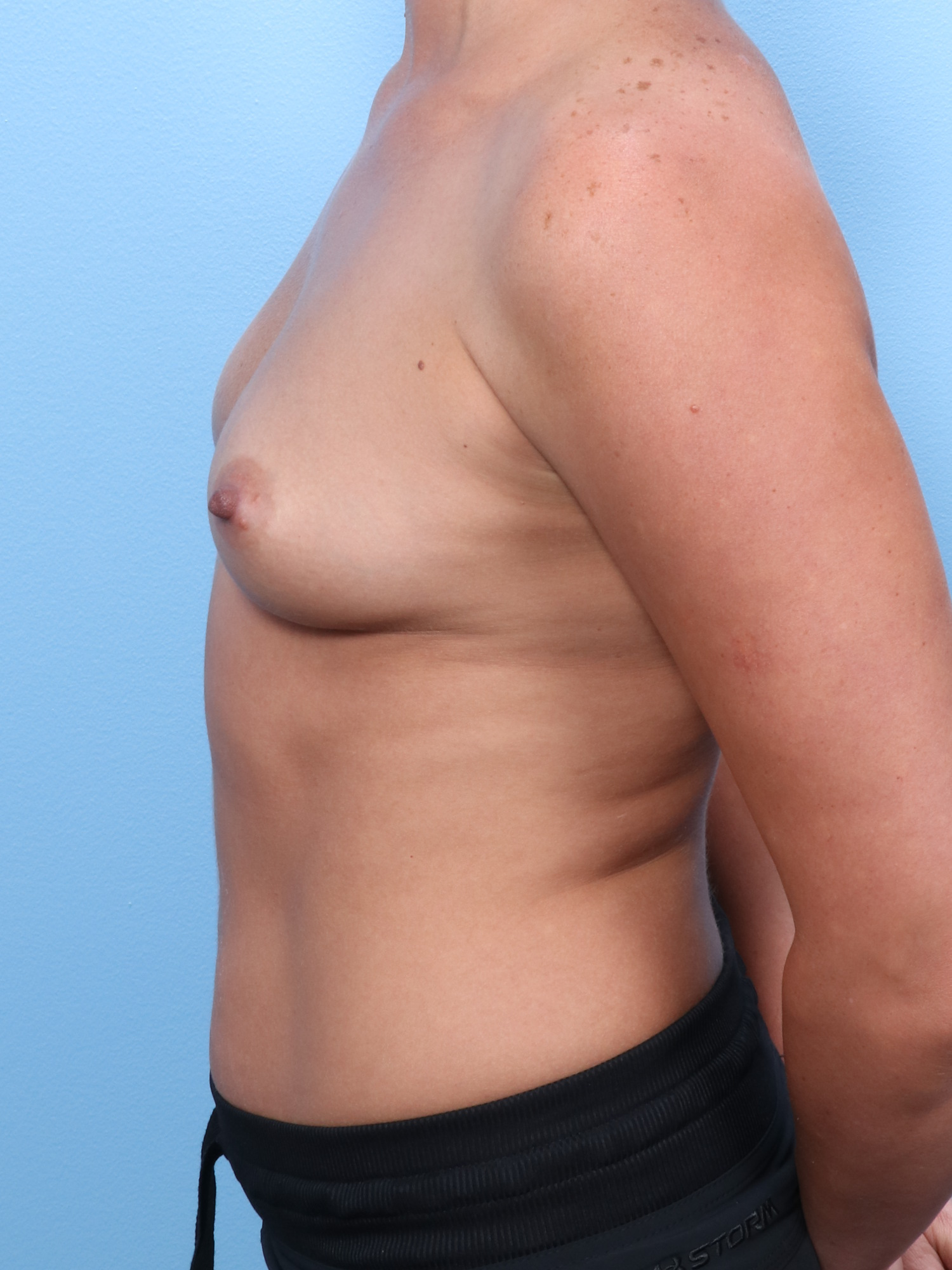 Breast Augmentation Patient Photo - Case 1707 - before view-2
