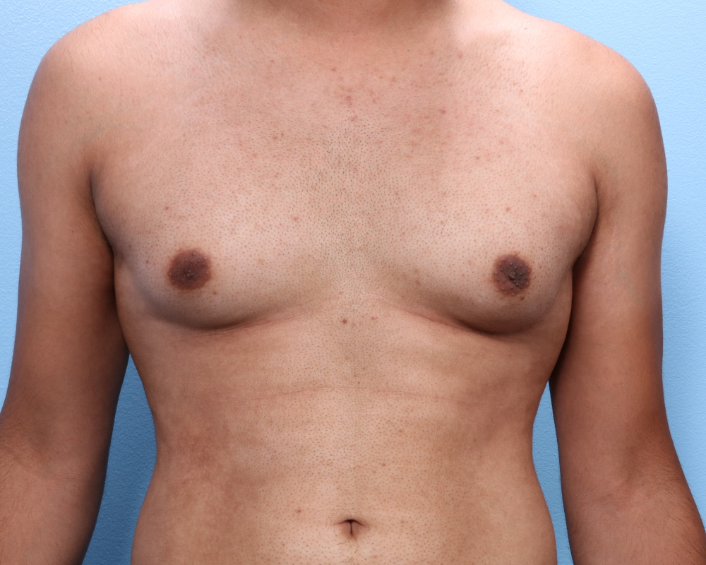 Gynecomastia - Case 1712 - Before
