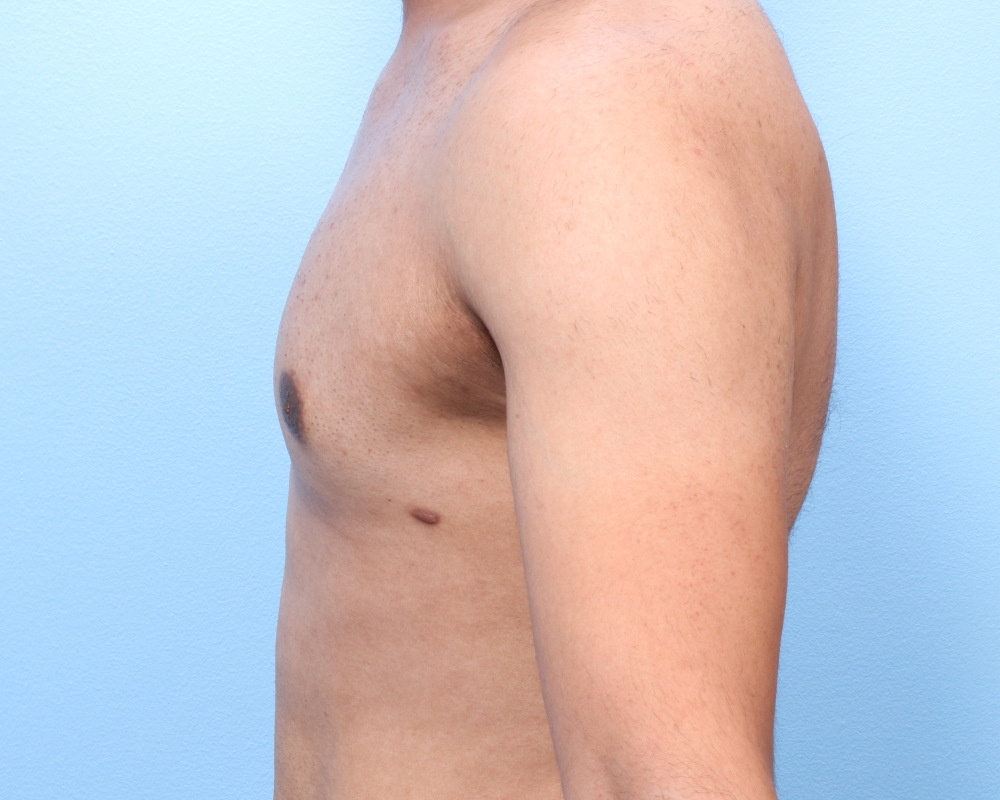 Gynecomastia Patient Photo - Case 1712 - after view-1
