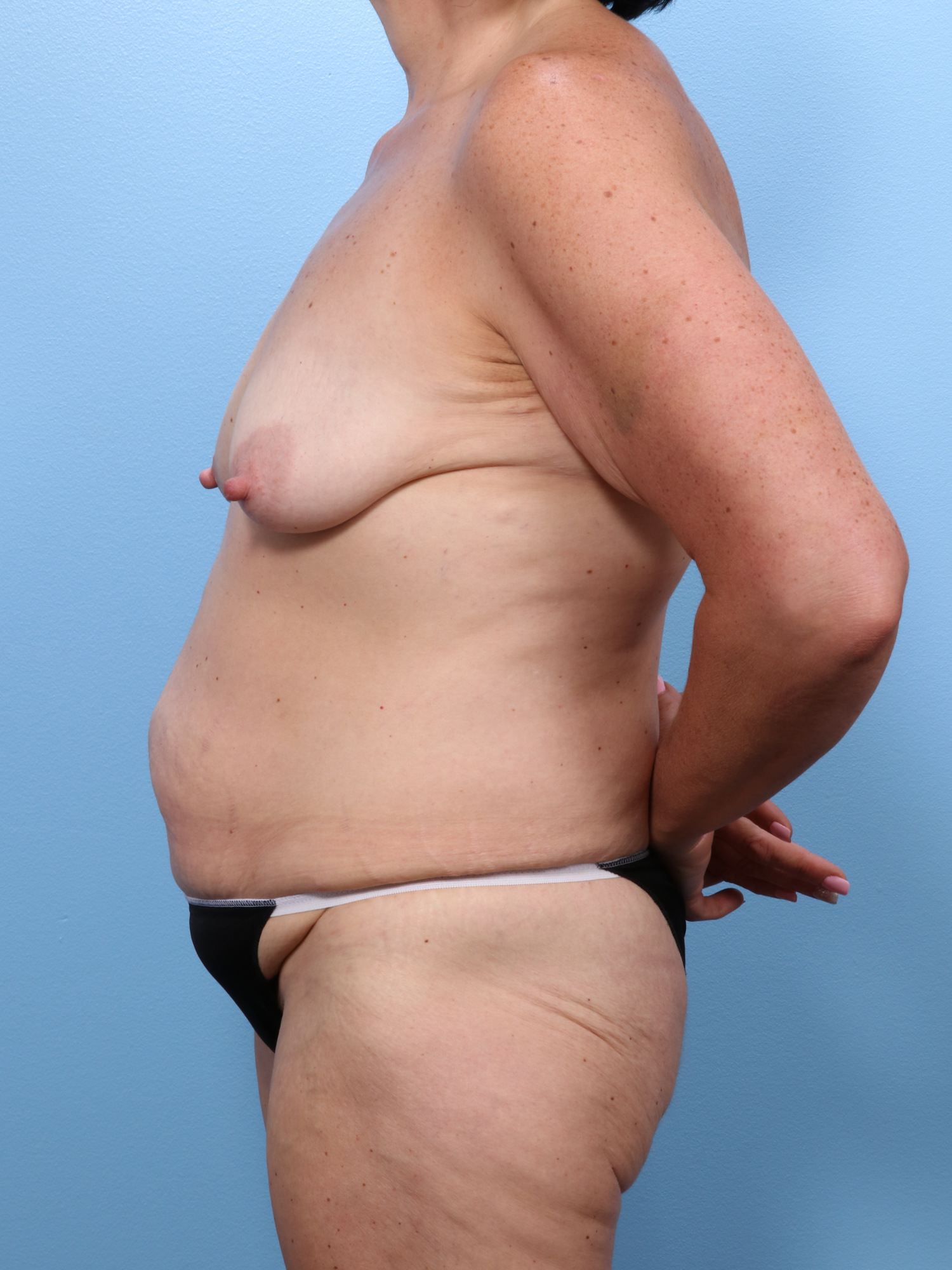 Mommy Makeover Patient Photo - Case 1720 - before view-2