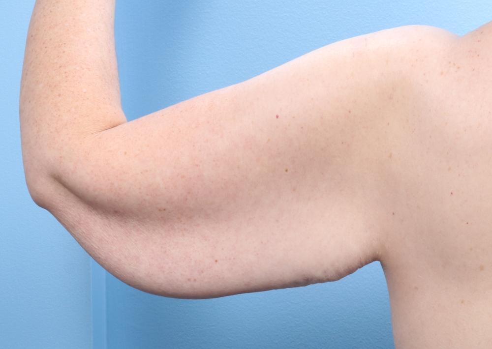 Arm Lift - Case 1728 - Before