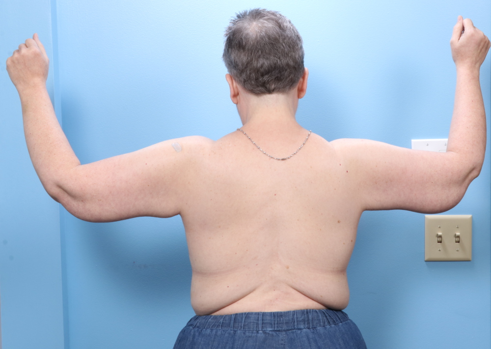 Arm Lift Patient Photo - Case 1728 - after view-1