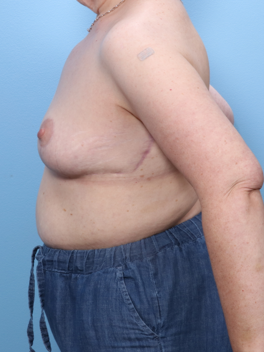 Breast Lift/Reduction w/o Implants Patient Photo - Case 1729 - after view-2