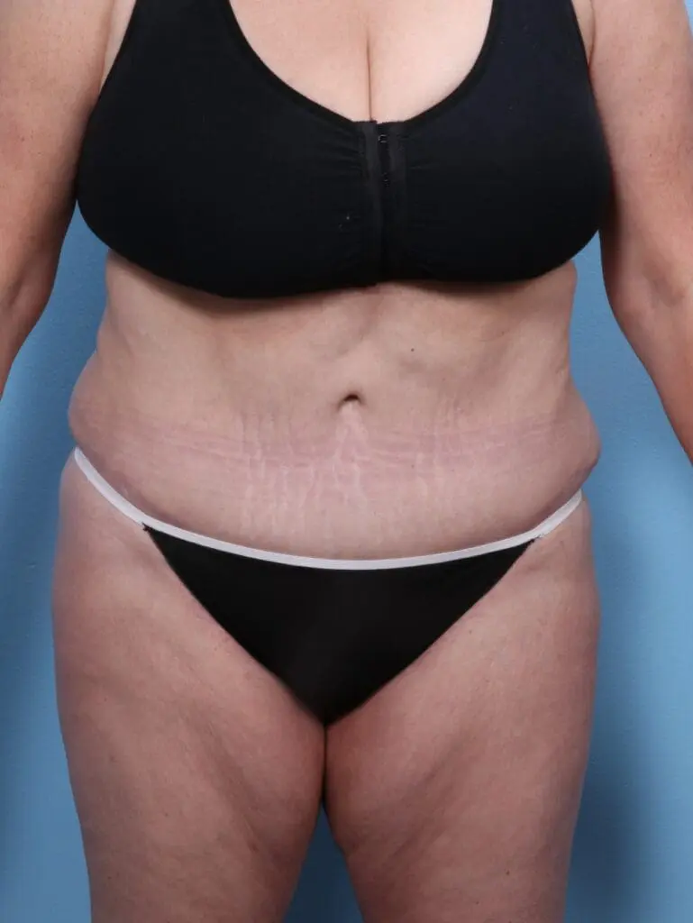 Tummy Tuck - Case 1737 - After