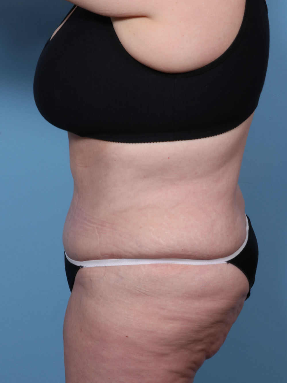 Tummy Tuck Patient Photo - Case 1737 - after view-2