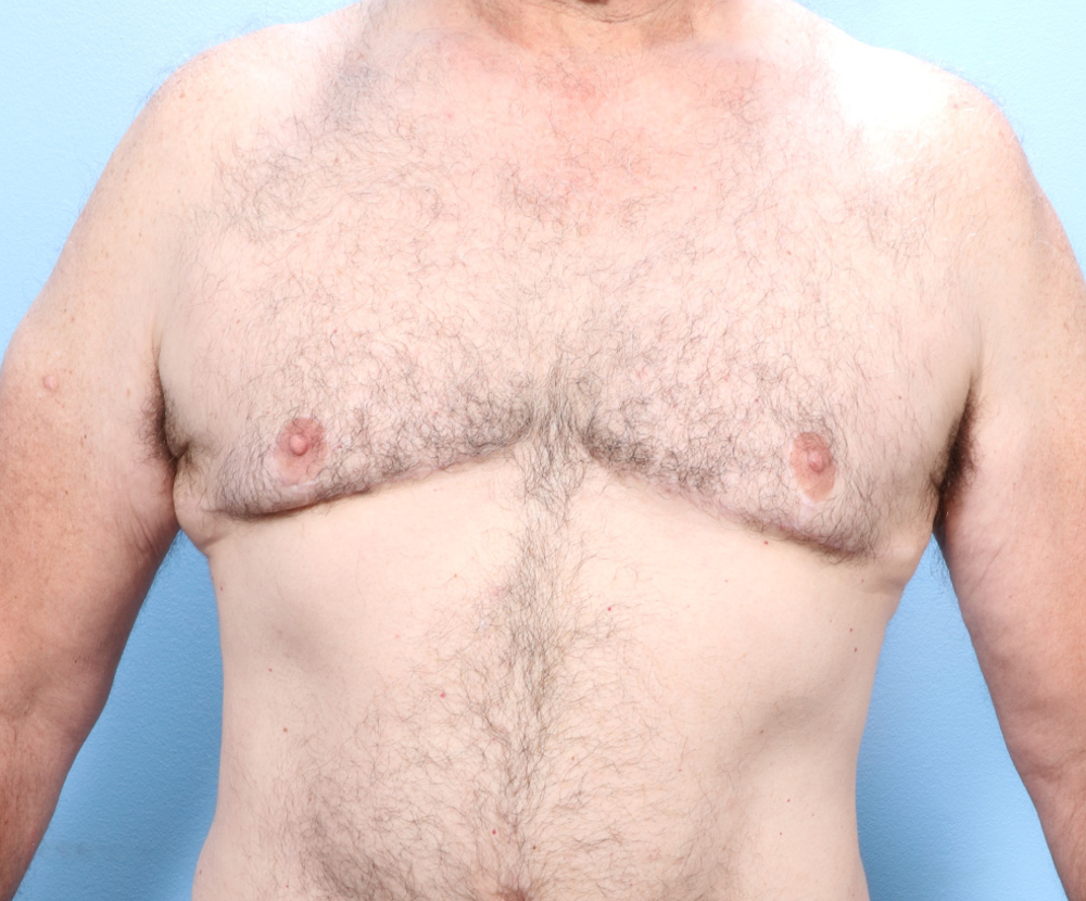 Gynecomastia - Case 1740 - After