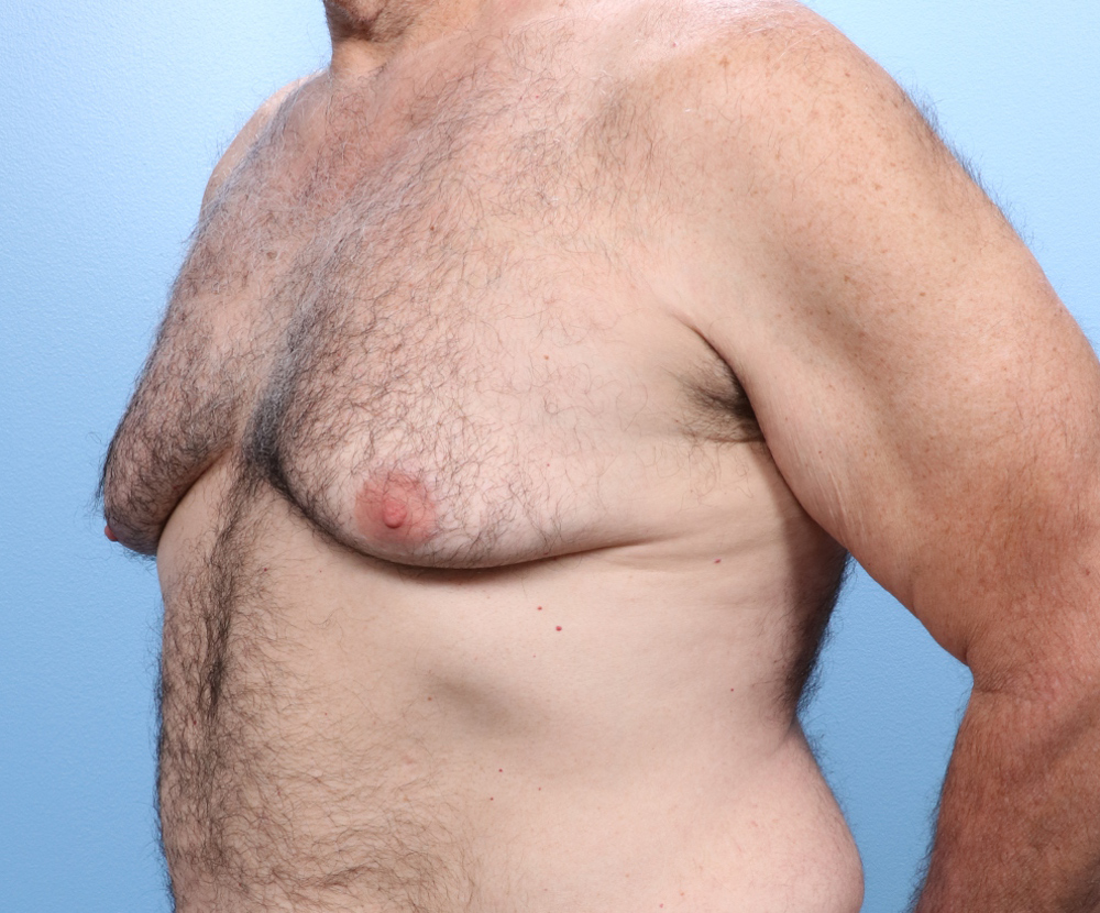 Gynecomastia Patient Photo - Case 1740 - before view-1