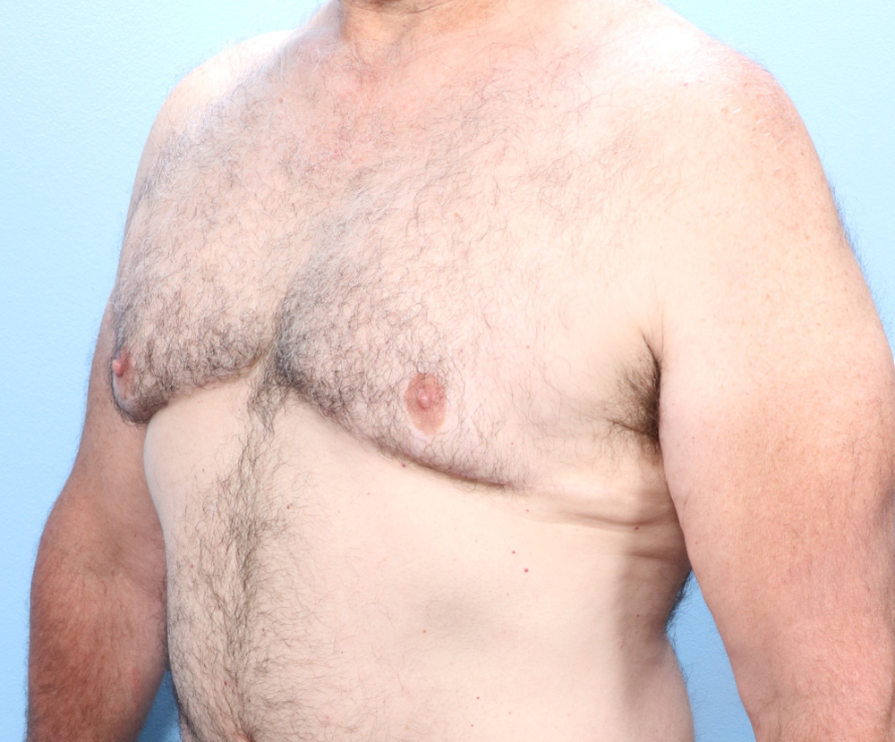 Gynecomastia Patient Photo - Case 1740 - after view-1