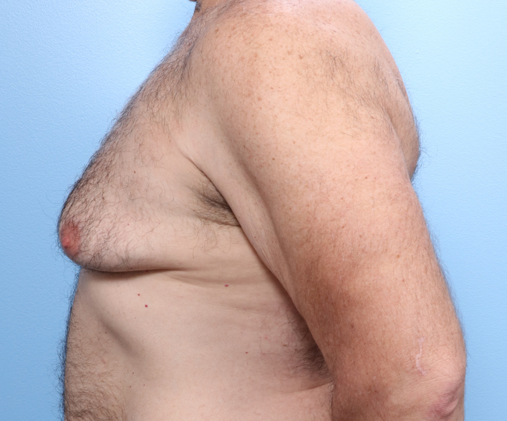Gynecomastia Patient Photo - Case 1740 - before view-2