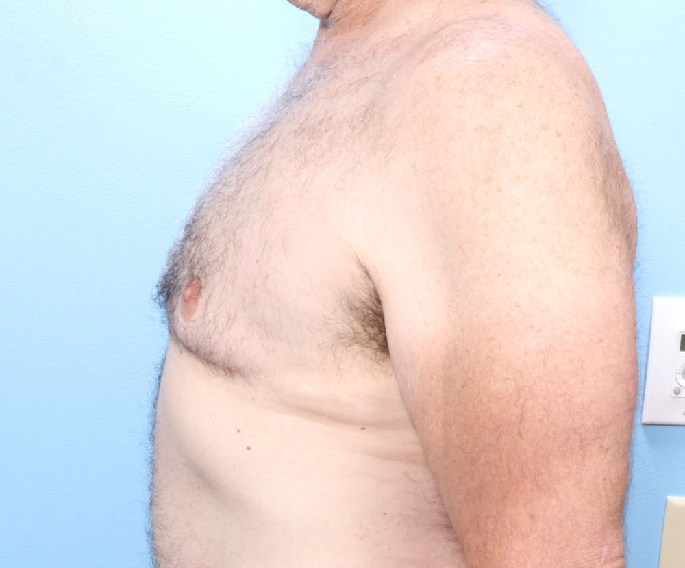 Gynecomastia Patient Photo - Case 1740 - after view-2