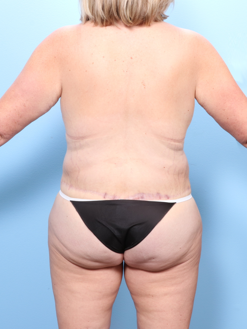 Body Lift Patient Photo - Case 1745 - after view-3