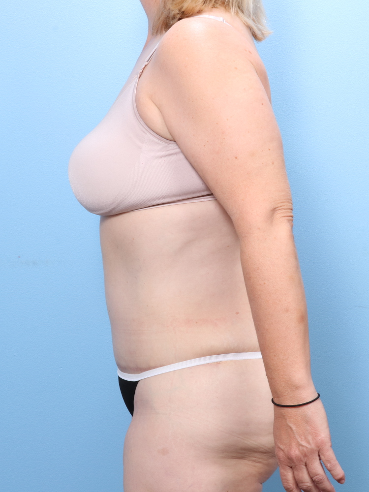 Tummy Tuck Patient Photo - Case 1746 - after view-2