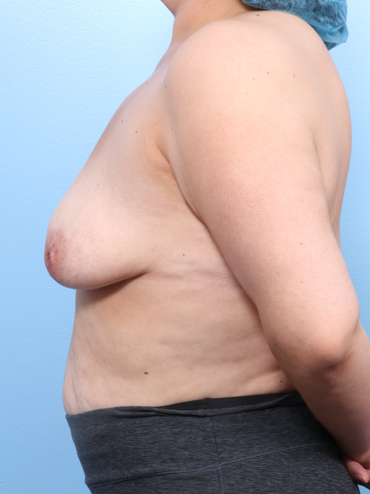 Breast Lift/Reduction with Implants Patient Photo - Case 1751 - before view-2