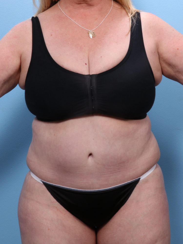 Tummy Tuck - Case 1757 - After